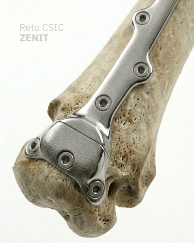 ZENIT – Personalized Femoral Fixation Plate - Innovation