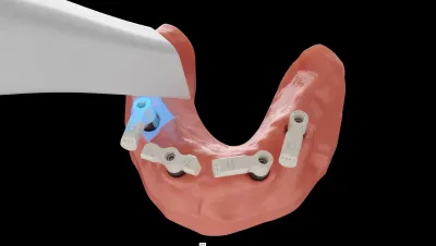 3D Dental Implant Animation & Visualization - 3D