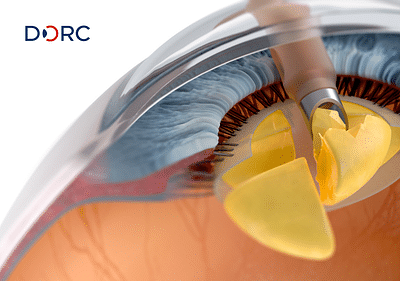 Ophthalmic surgery animations - Social media