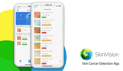 SkinVision - Skin Cancer Melanoma Detection App